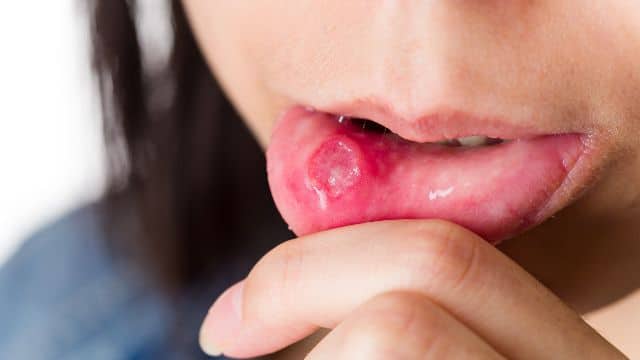 Como cuidar de aftas na boca e na língua
