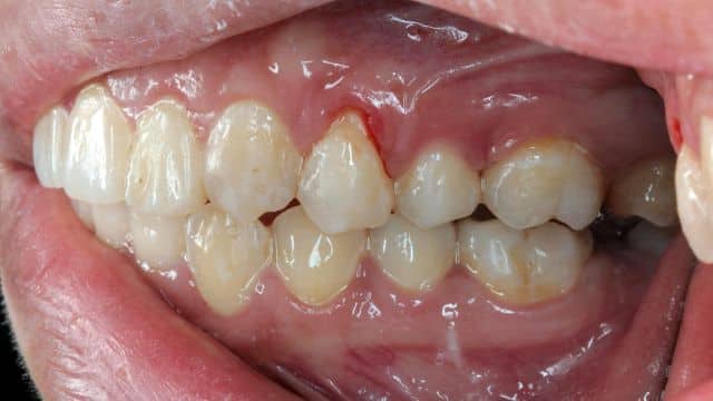 Gengiva e dentes, como cuidar da gengiva inflamada